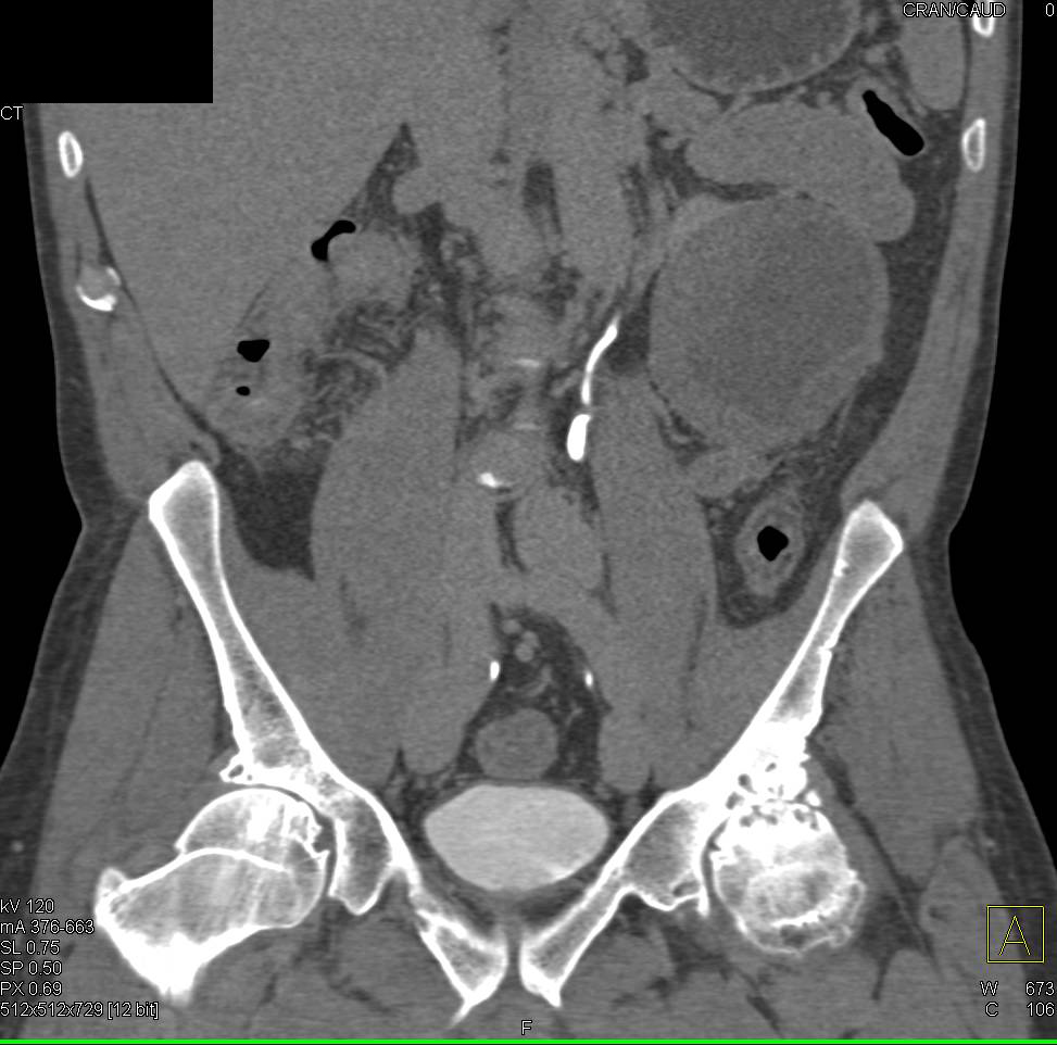 Significant Degenerative Joint Disease (DJD) of Left Hip Joint and Colitis - CTisus CT Scan