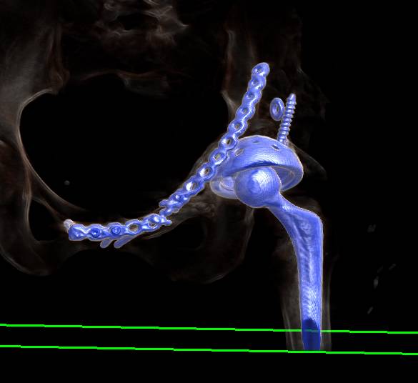 Color Coded Left Acetabular Repair and Total Hip Replacement (THR) - CTisus CT Scan