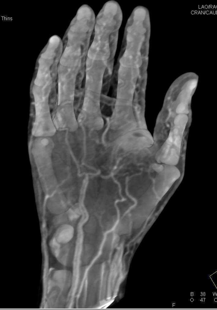 Cellulitis of the Hand - CTisus CT Scan