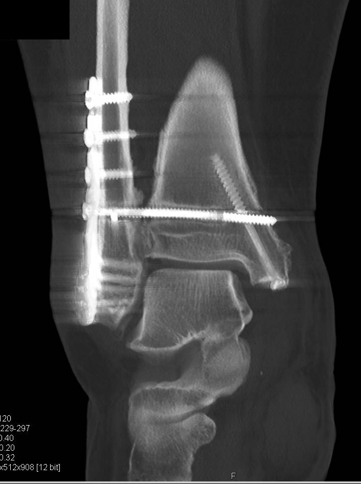 Fractured Hardware S/P Repair of Fracture - CTisus CT Scan