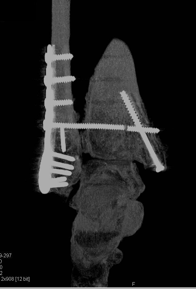 3D of Hardware Showing a Fractured Screw - CTisus CT Scan