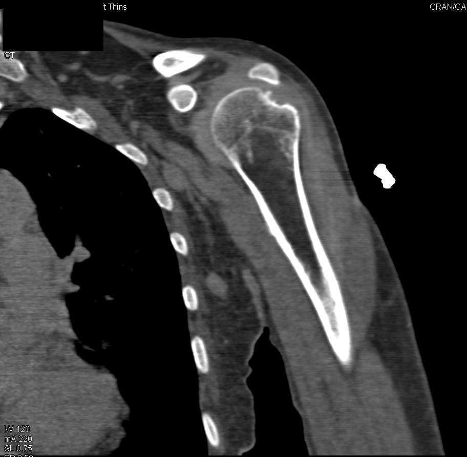 Hill-Sachs Deformity Following Dislocation of Shoulder - CTisus CT Scan