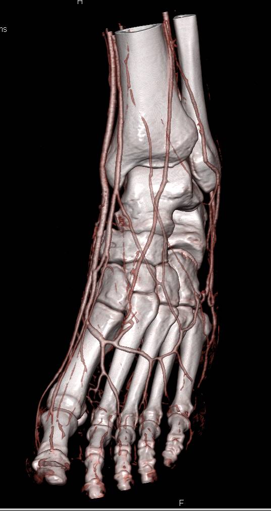 3D Map of the Foot - CTisus CT Scan