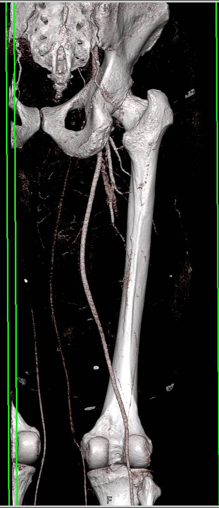 Intramuscular Abscess Thigh Without Vascular Involvement - CTisus CT Scan