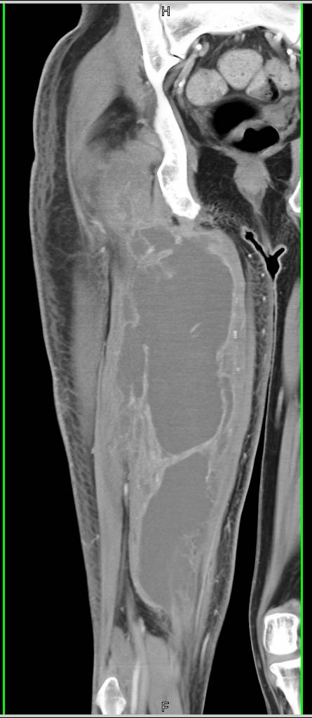 Intramuscular Bleed Without Vascular Involvement - CTisus CT Scan