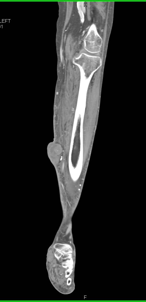 Malignant Melanoma - CTisus CT Scan