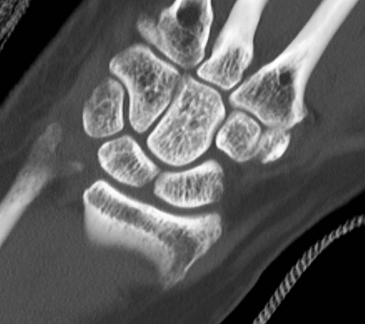 Subtle Carpal Bone Fractures - CTisus CT Scan