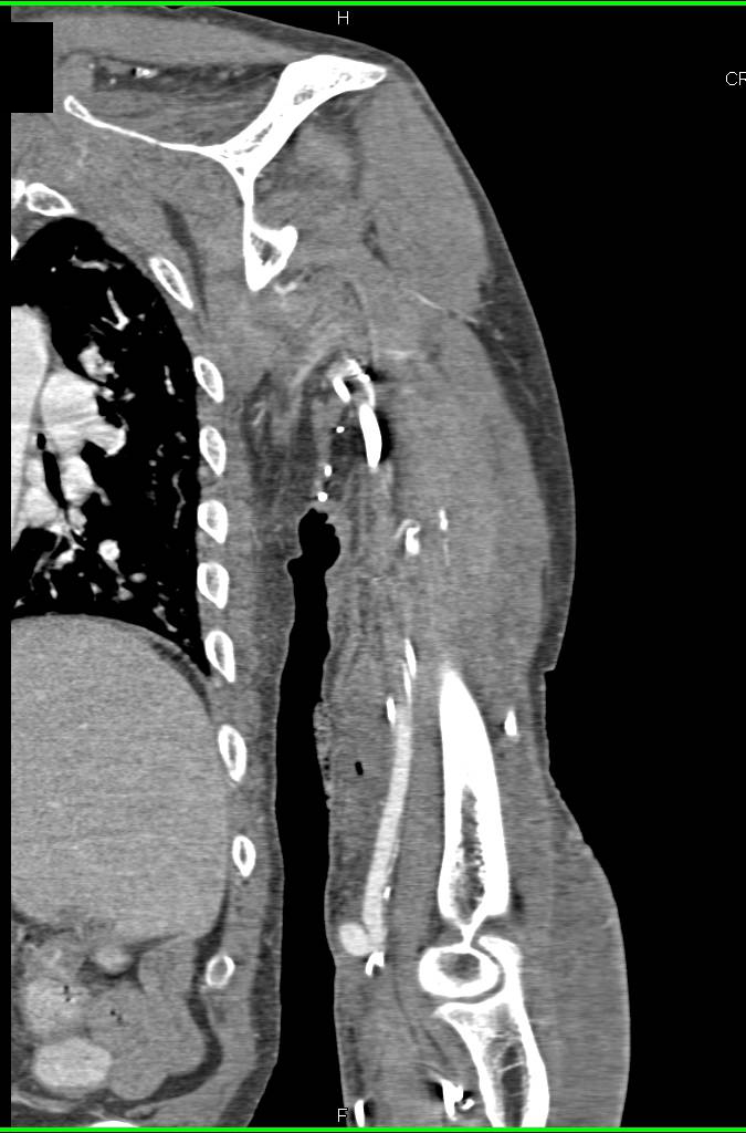 CTA Arm with Arteriovenous (AV) Shunting - CTisus CT Scan