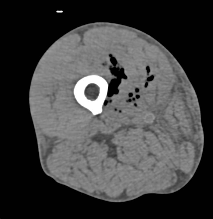 Necrotizing Fasciitis - CTisus CT Scan