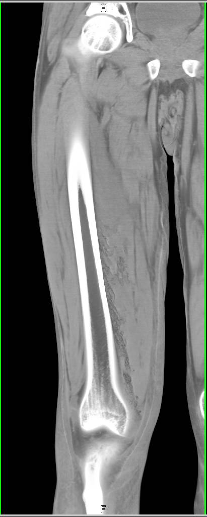 Necrotizing Fasciitis - CTisus CT Scan