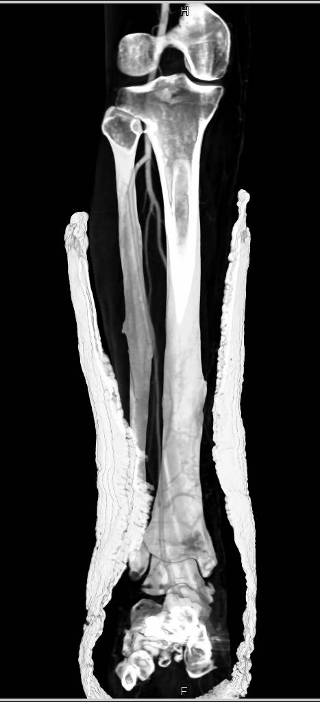 CTA in Patient with Lower Extremity Trauma - Musculoskeletal Case ...