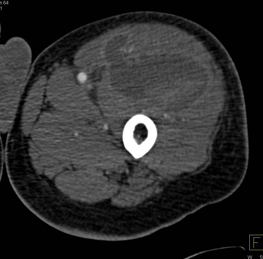 Spontaneous Bleed Left Thigh in Patient on Anticoagulant Therapy - CTisus CT Scan