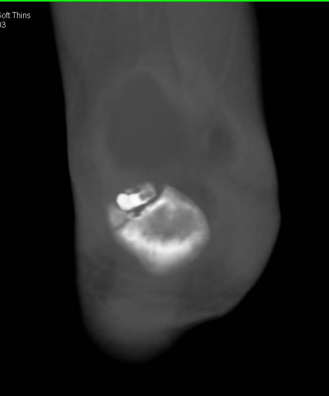 Patella Fracture - CTisus CT Scan