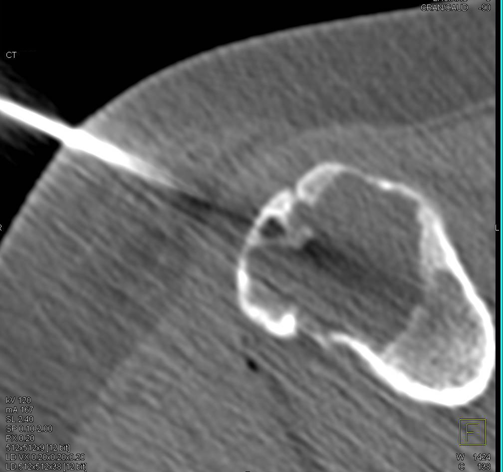 Ablation of an Osteoid Osteoma - CTisus CT Scan