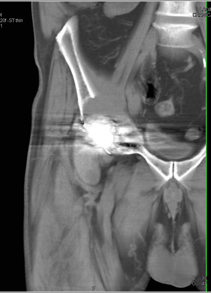 Lytic Lesion Acetabulum at Hip Prosthesis due to Particle Disease - CTisus CT Scan