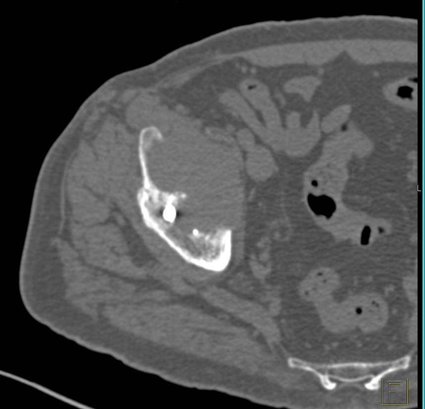 Multiple Myeloma - Musculoskeletal Case Studies - CTisus CT Scanning