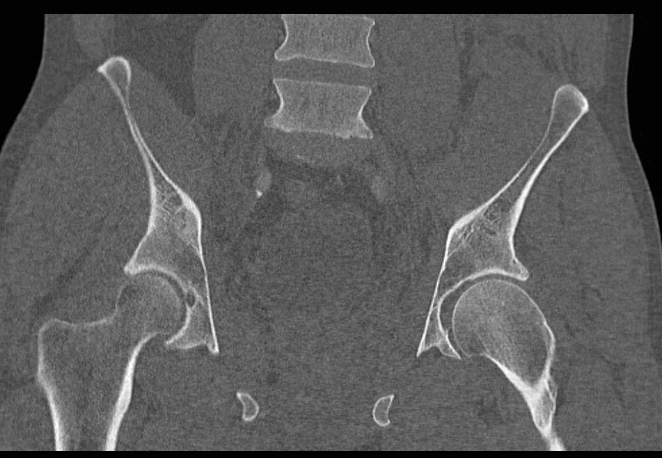 Pelvic Hematoma due to Complex Pelvic Fracture - CTisus CT Scan