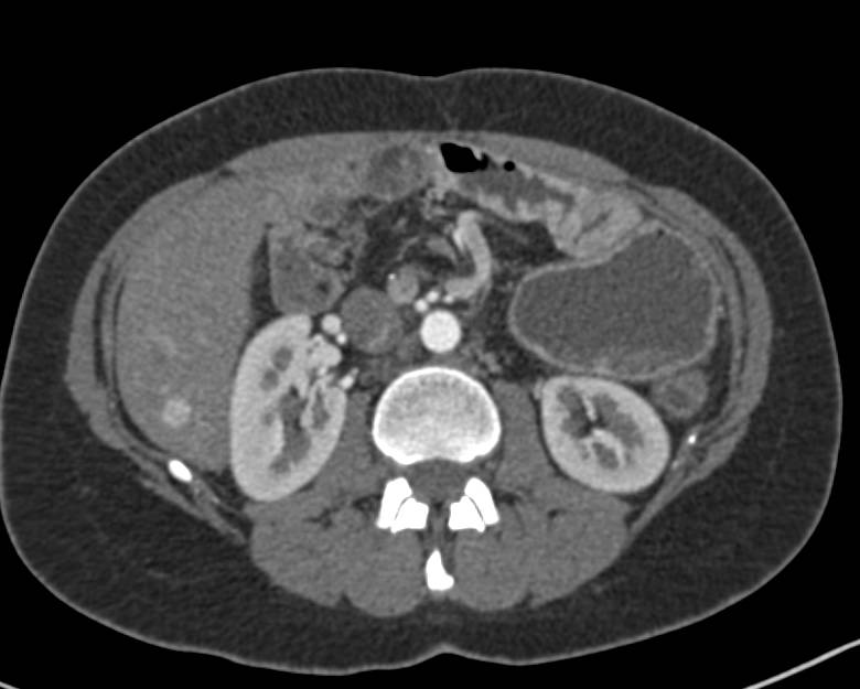 Desmoid Tumor in Left Rectus Muscle - CTisus CT Scan