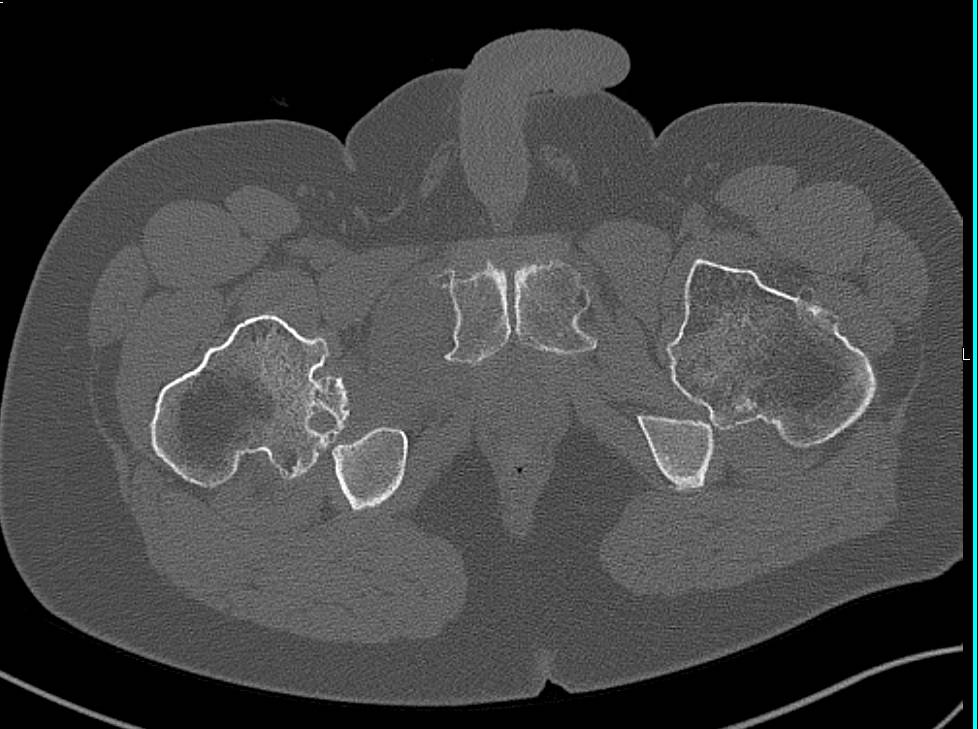 Hereditary Multiple Exostoses - CTisus CT Scan