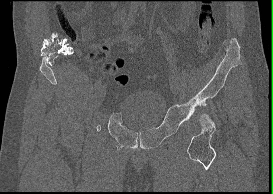 Hereditary Multiple Exostoses - CTisus CT Scan