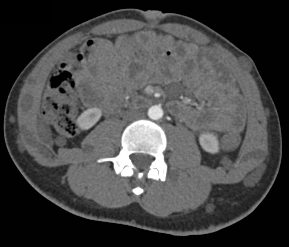 Classic Case of Neurofibromatosis with Classic Skin Lesions and Pelvic Neurofibromas - CTisus CT Scan