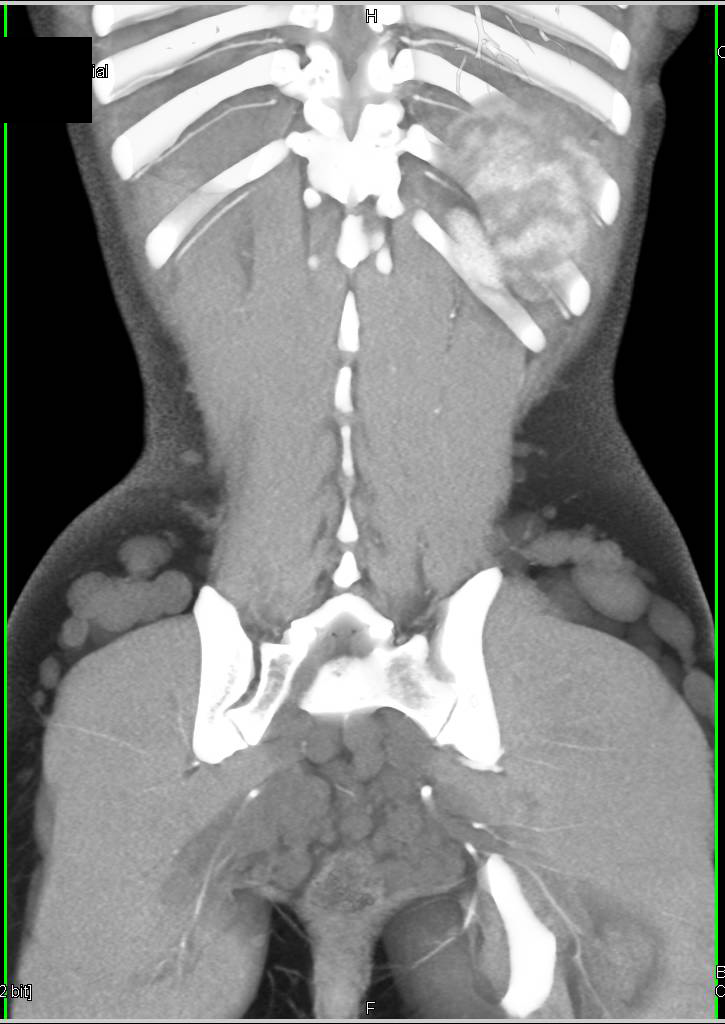 Neurofibromatosis with Subcutaneous Nodules - CTisus CT Scan