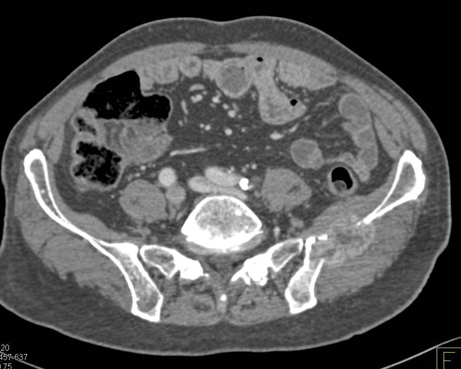 Metastatic Renal Cell Carcinoma to Bone with Vascular Lesions - CTisus CT Scan