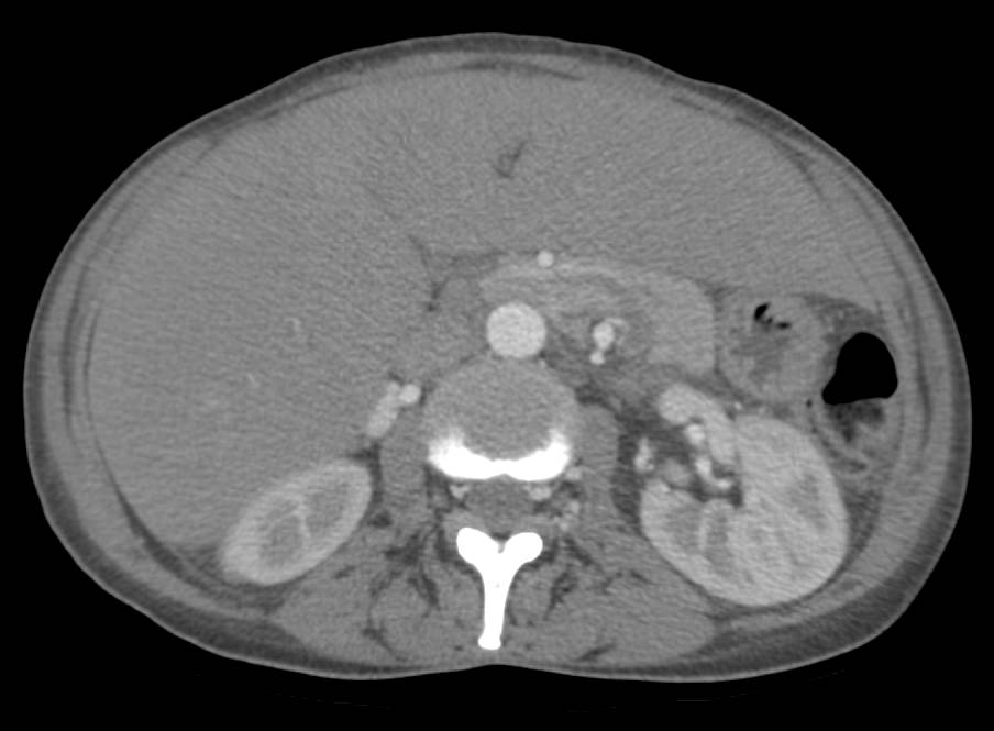 Mastocytosis with Sclerotic Bone Lesions - CTisus CT Scan