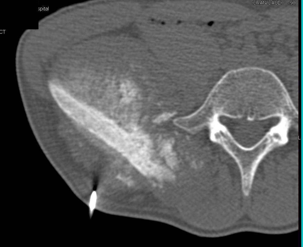 Osteosarcoma with Osteoid Matrix (Pre and Post Resection) - CTisus CT Scan