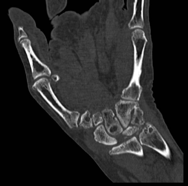 Degenerative Joint Disease (DJD) Carpal Bones with Non-Displaced Scaphoid Fracture - CTisus CT Scan