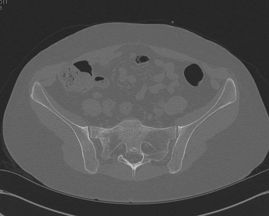 Sacral Stress Fracture - CTisus CT Scan