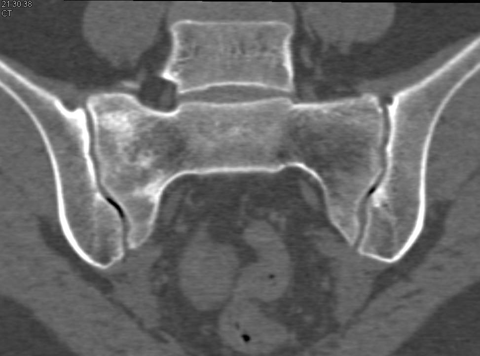 Sacral Stress Fracture - CTisus CT Scan