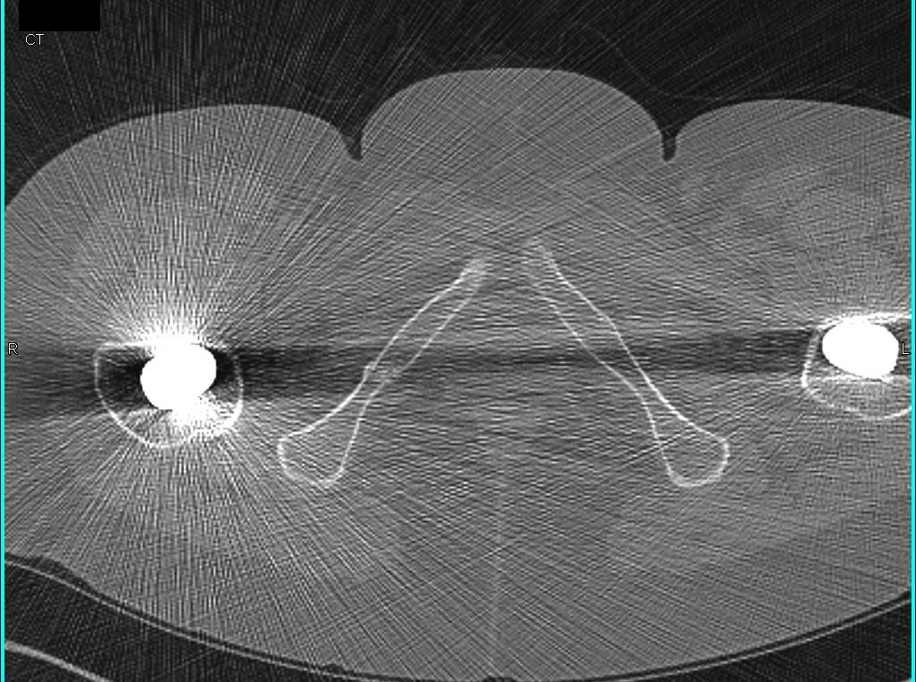 Bilateral Total Hips with Inferior Right Pubic Ramus and Sacral Stress Fractures - CTisus CT Scan