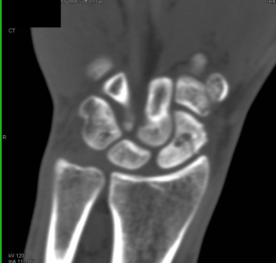 Nonunion of a Scaphoid Fracture - CTisus CT Scan