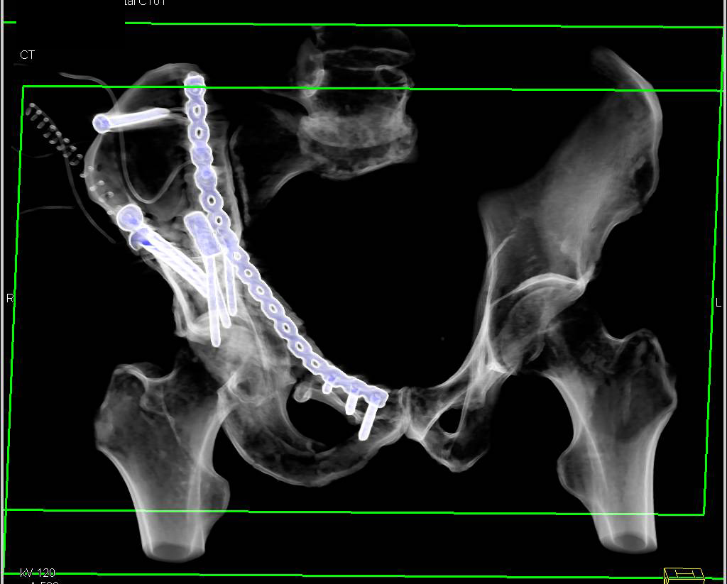 Surgical Repair of Complex Pelvic Fractures with Hardware in Place