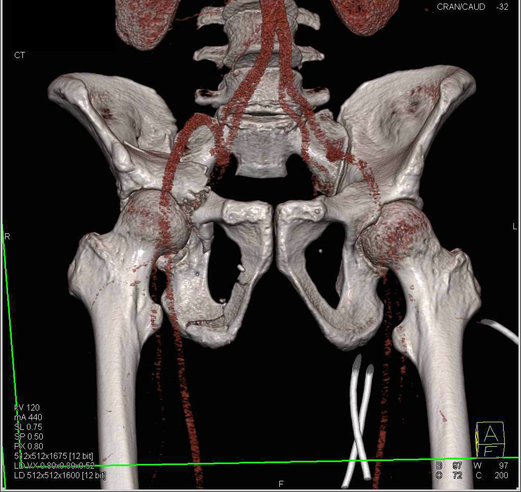 Trauma with CTA and CT Cystogram with Pelvic Fractures. No evidence of Vascular Injury - CTisus CT Scan
