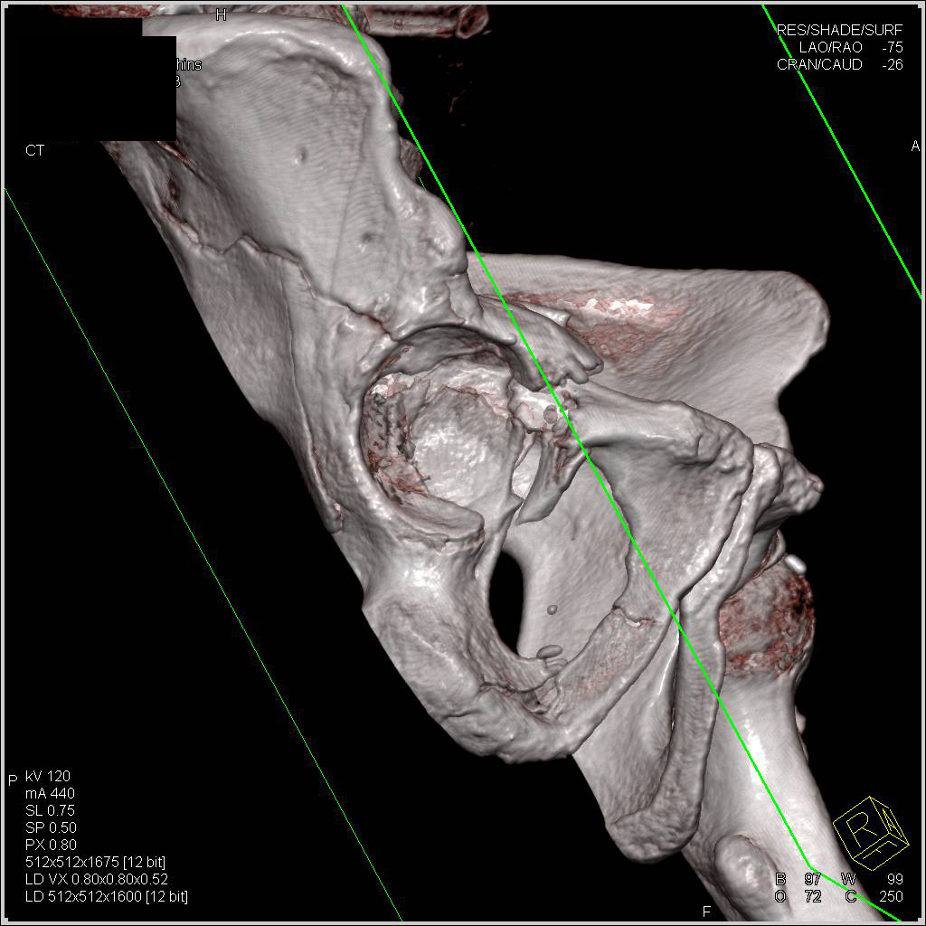 Acetabular Fracture with Disarticulation - CTisus CT Scan