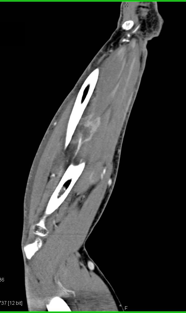 Intramuscular Abscess - CTisus CT Scan