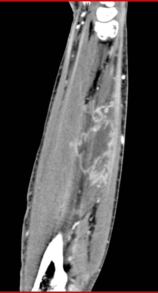 Abscess in the Forearm - CTisus CT Scan