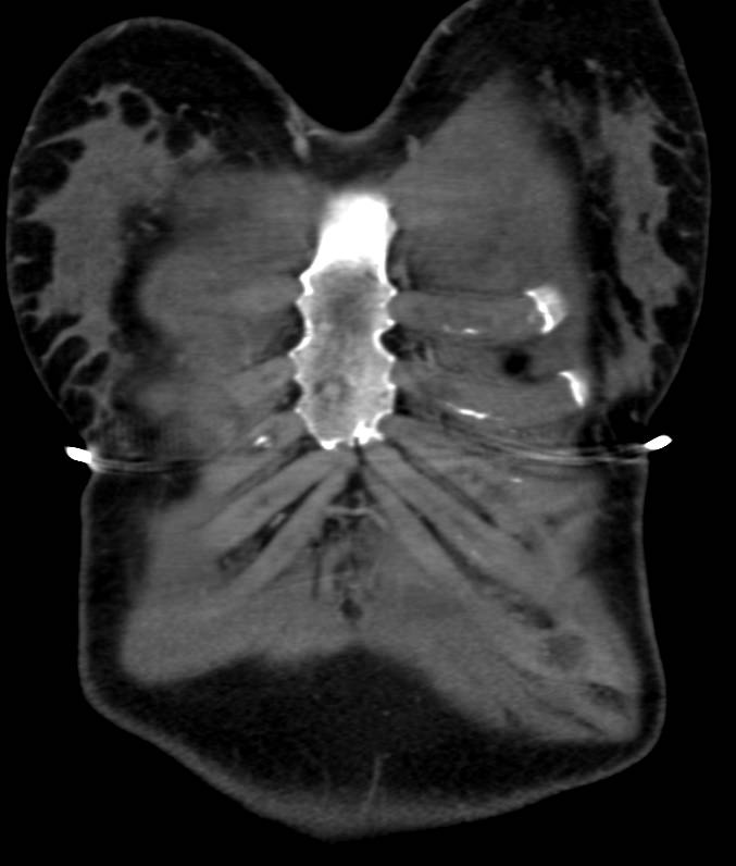 3D Relationship of Sternum and Ribs - CTisus CT Scan