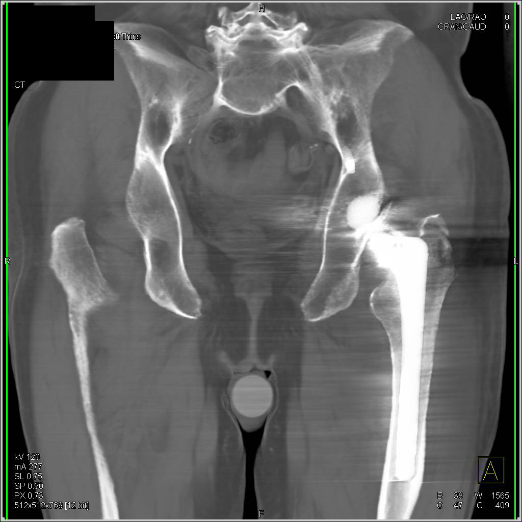 3D of Slipped Femoral Head Component with Soft Tissue Swelling - CTisus CT Scan