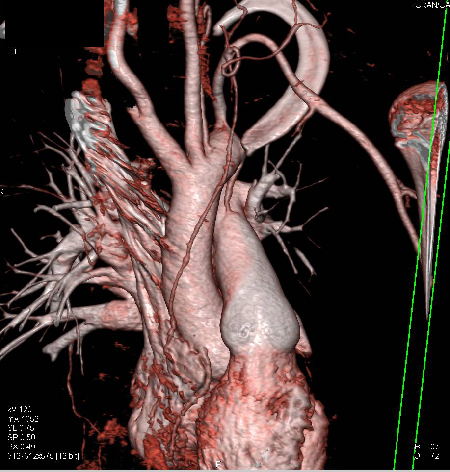 Severe Pectus Deformity in Marfan Patient - CTisus CT Scan