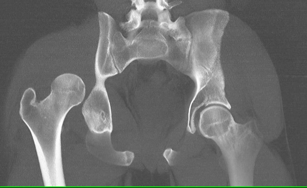 Right Hip Dislocation in 3D VRT - CTisus CT Scan