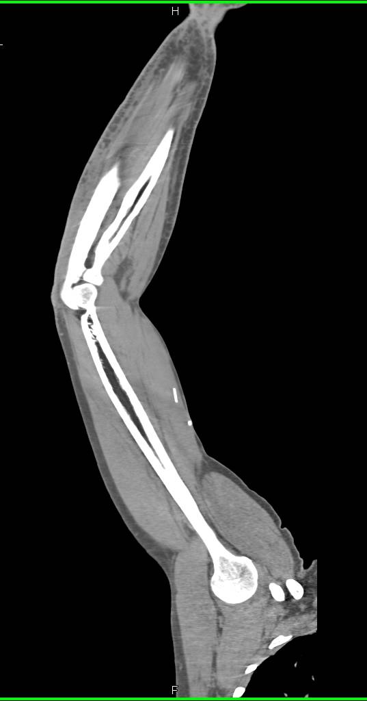 Broken Needles Upper Arm from IVDA - CTisus CT Scan