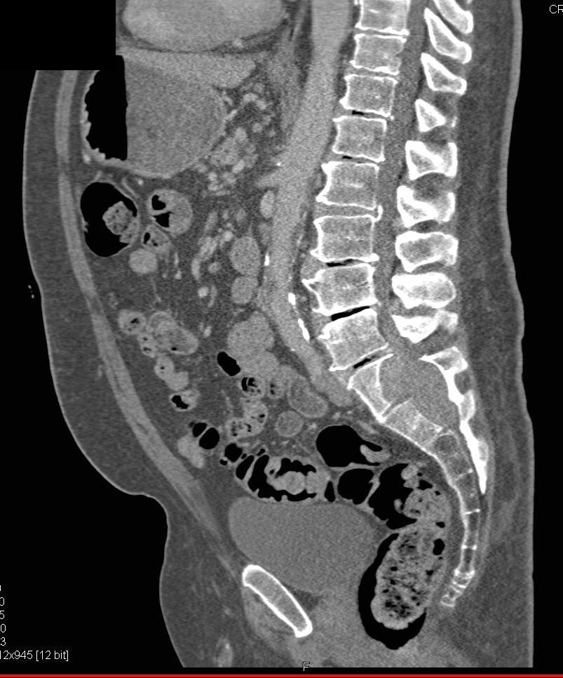 Neurofibroma Erodes Bone - CTisus CT Scan