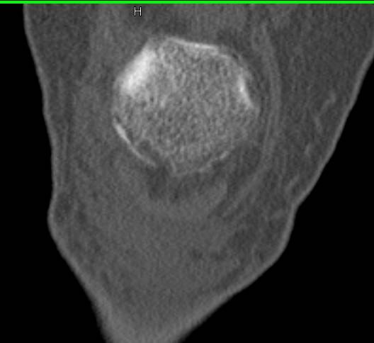 Multiple Fractures Including Patella and Talus Fractures - CTisus CT Scan