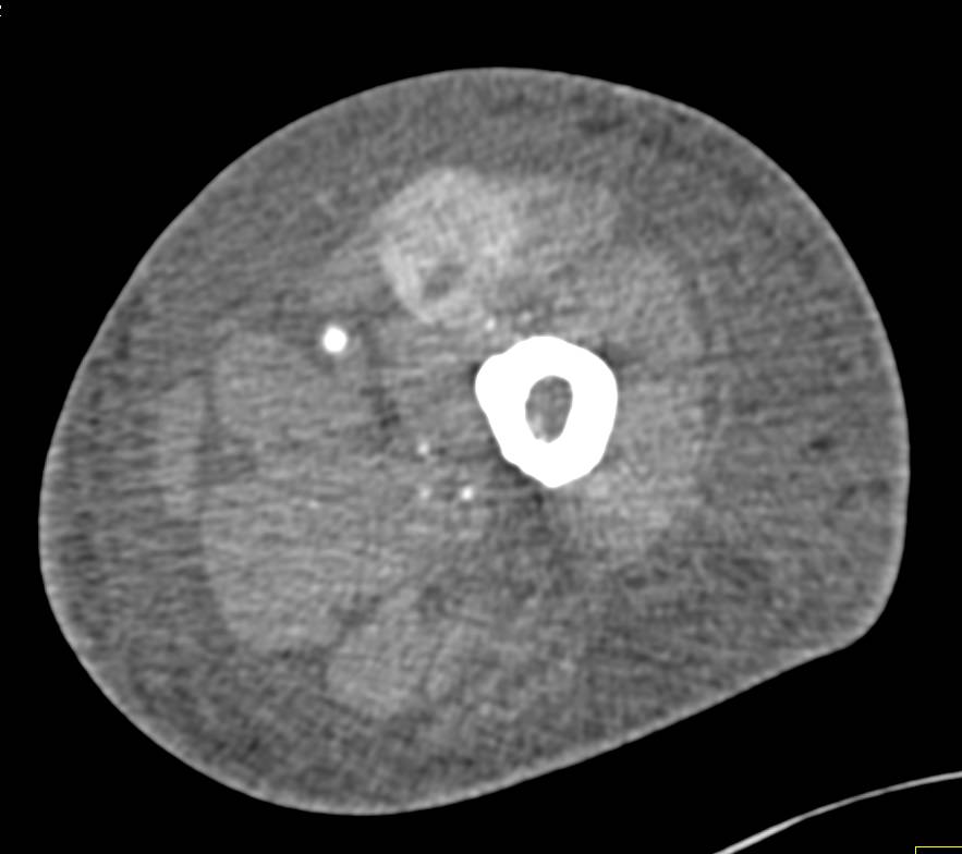 Hematoma Left Thigh - CTisus CT Scan