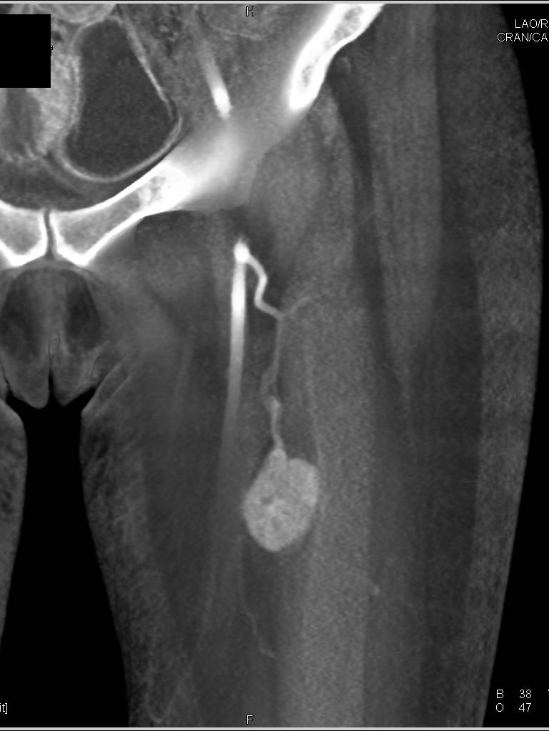 Vascular Sarcoma Left Thigh Seen on CTA - CTisus CT Scan