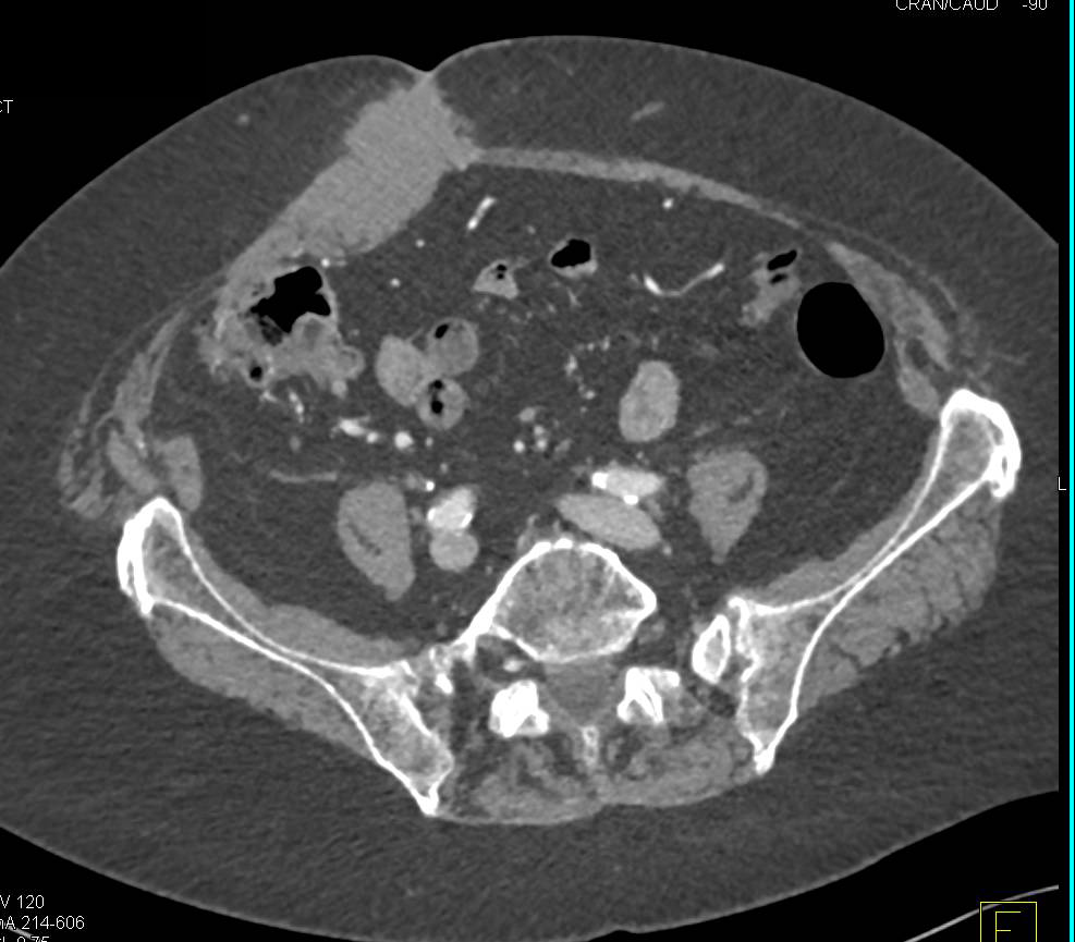 Desmoid Tumor Abdominal Wall - CTisus CT Scan