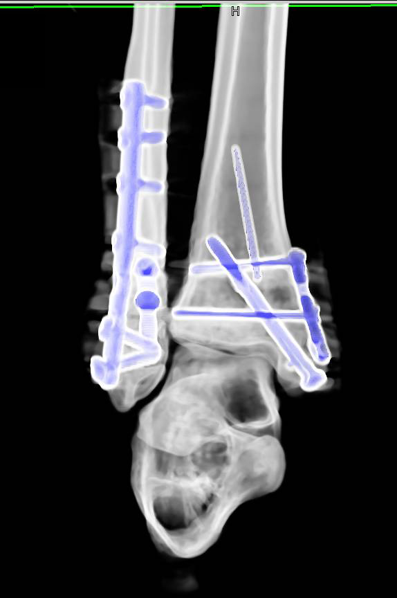 Open Reduction Internal Fixation (ORIF) of Tibia and Fibular Fractures - CTisus CT Scan